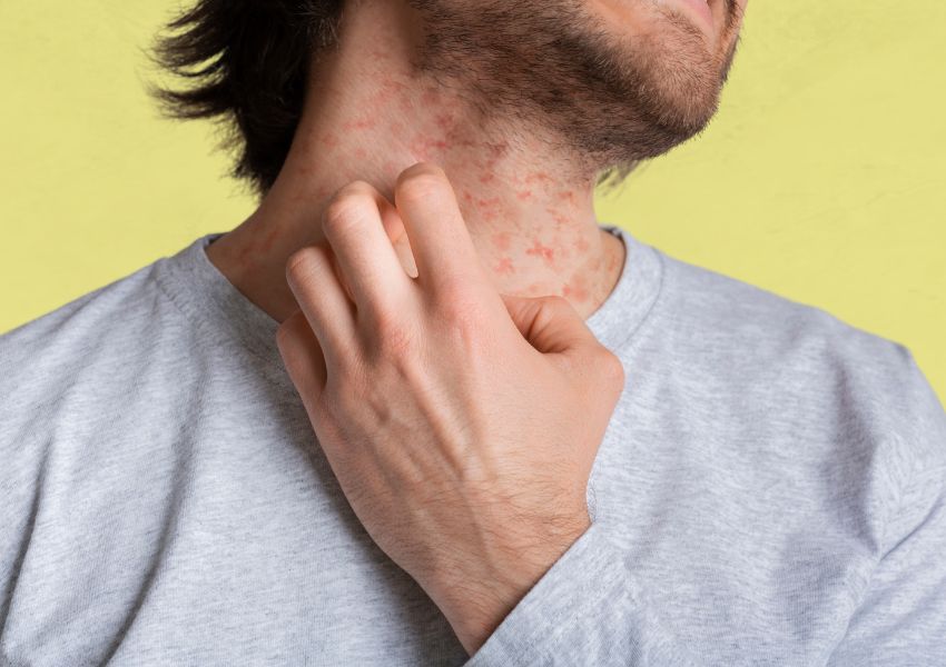 Types of Eczema Symptoms, Pictures, Causes, and Treatment