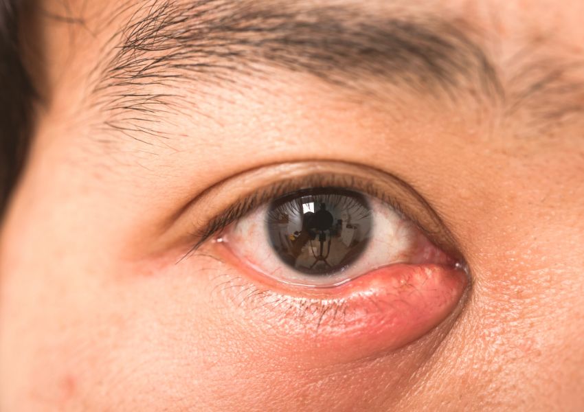 what is the difference between stye and chalazion?