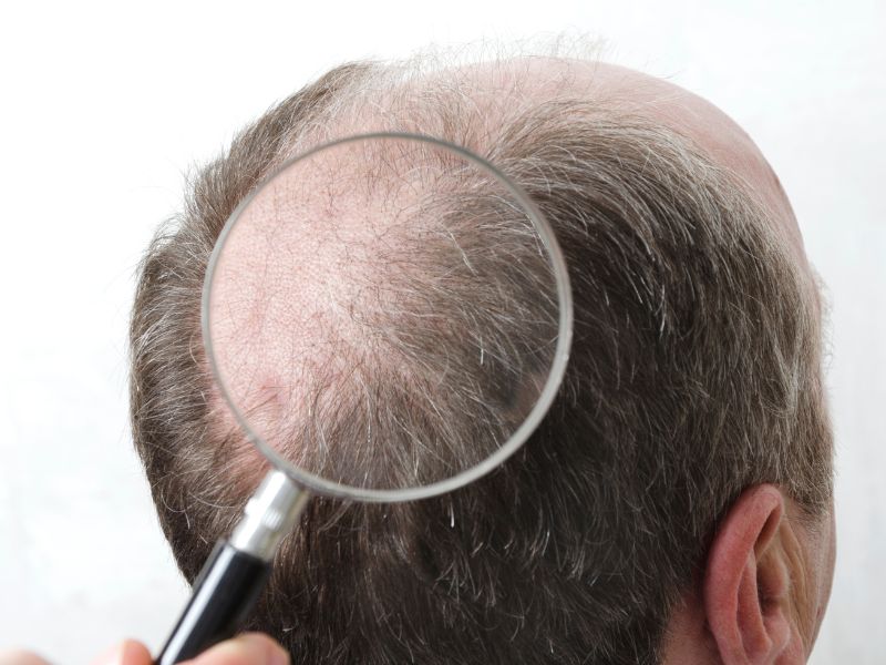 Minoxidil Vs. Nanoxidil: Comparing Benefits For Hair Growth